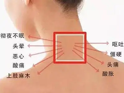 颈椎病的临床表现