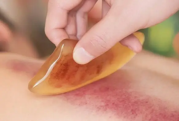 酷夏中暑 穴位刮痧来急救